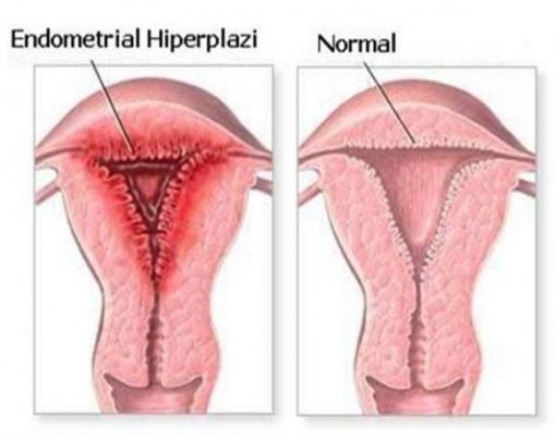  rahim zarı kalınlaşması - endometrial hiperplazi