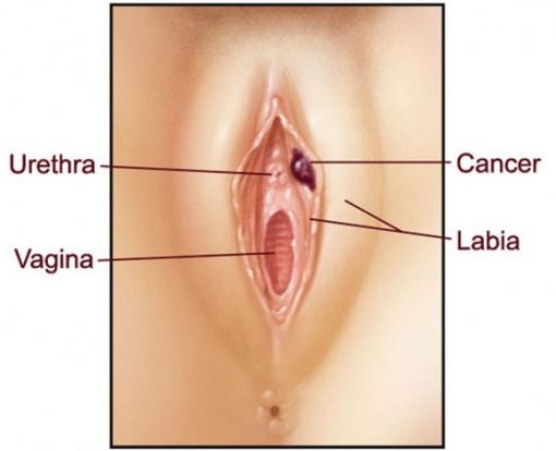 vulva kanseri